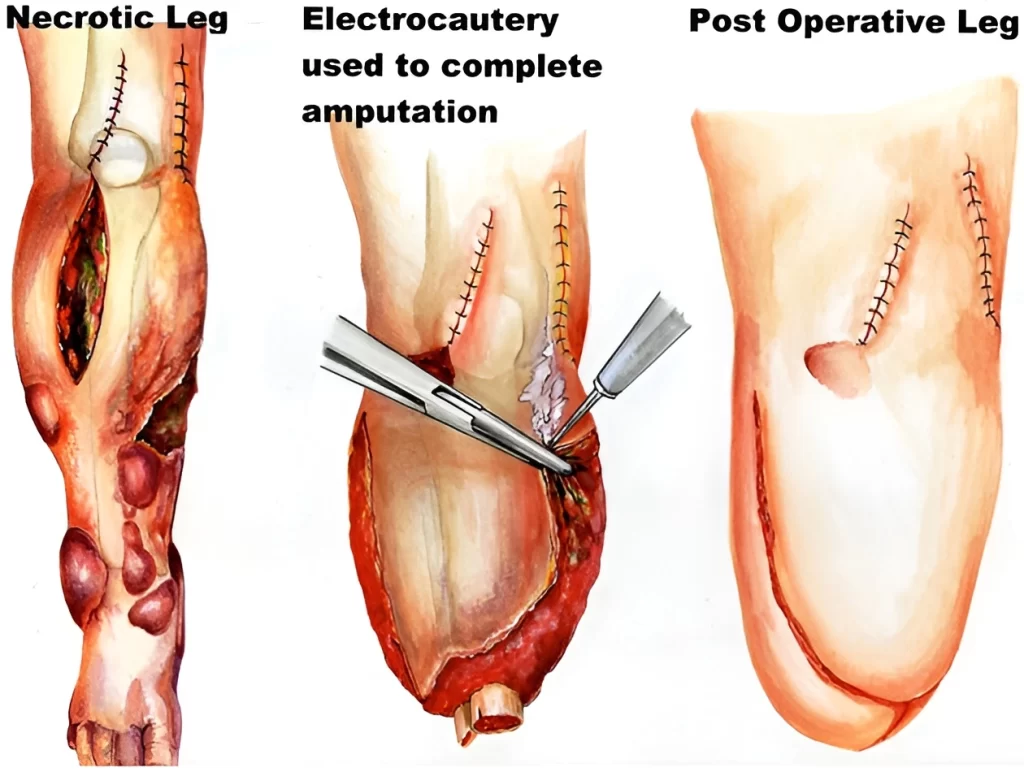 Amputation