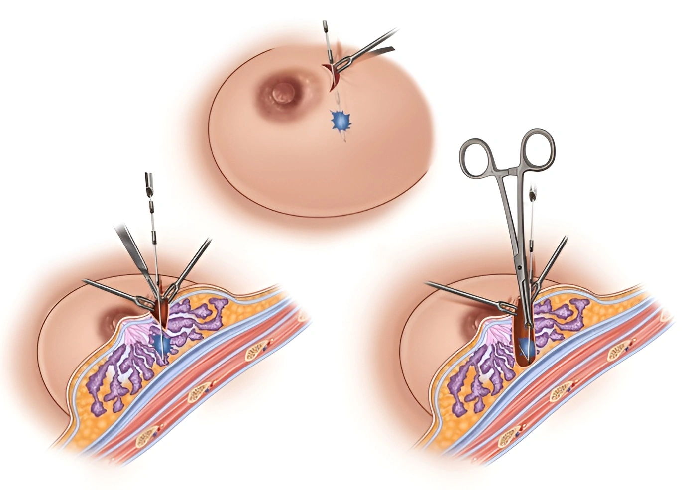 Breast Conditions