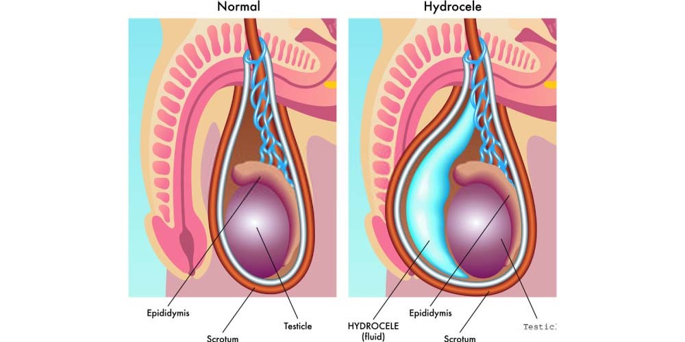 1Hydrocele