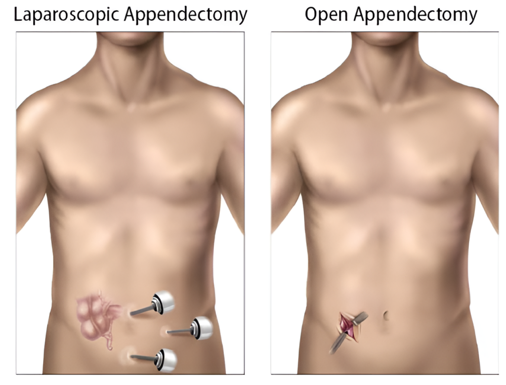 Appendicectomy