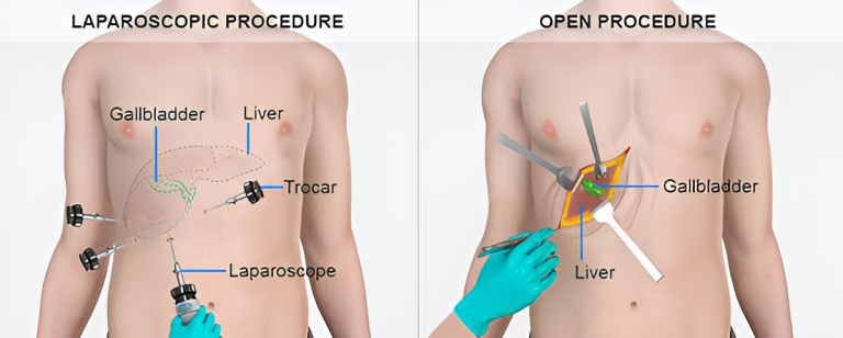 Cholecystectomy 768x308 1