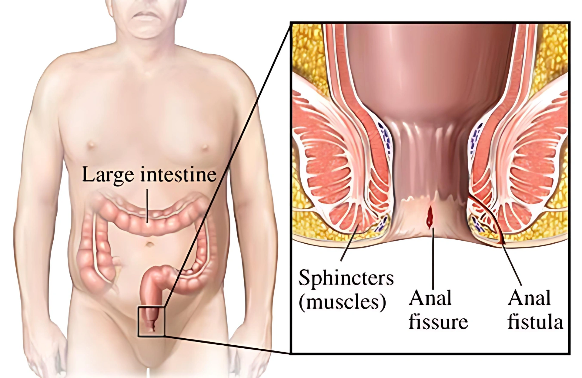 Fistulectomy