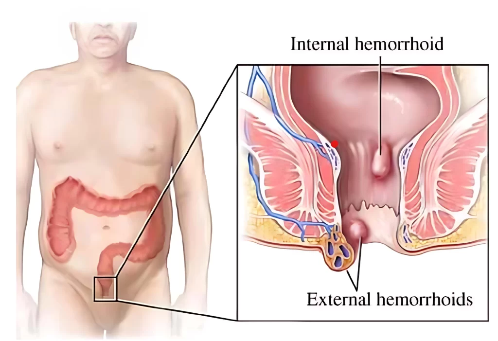 Hemorrhoidectomy