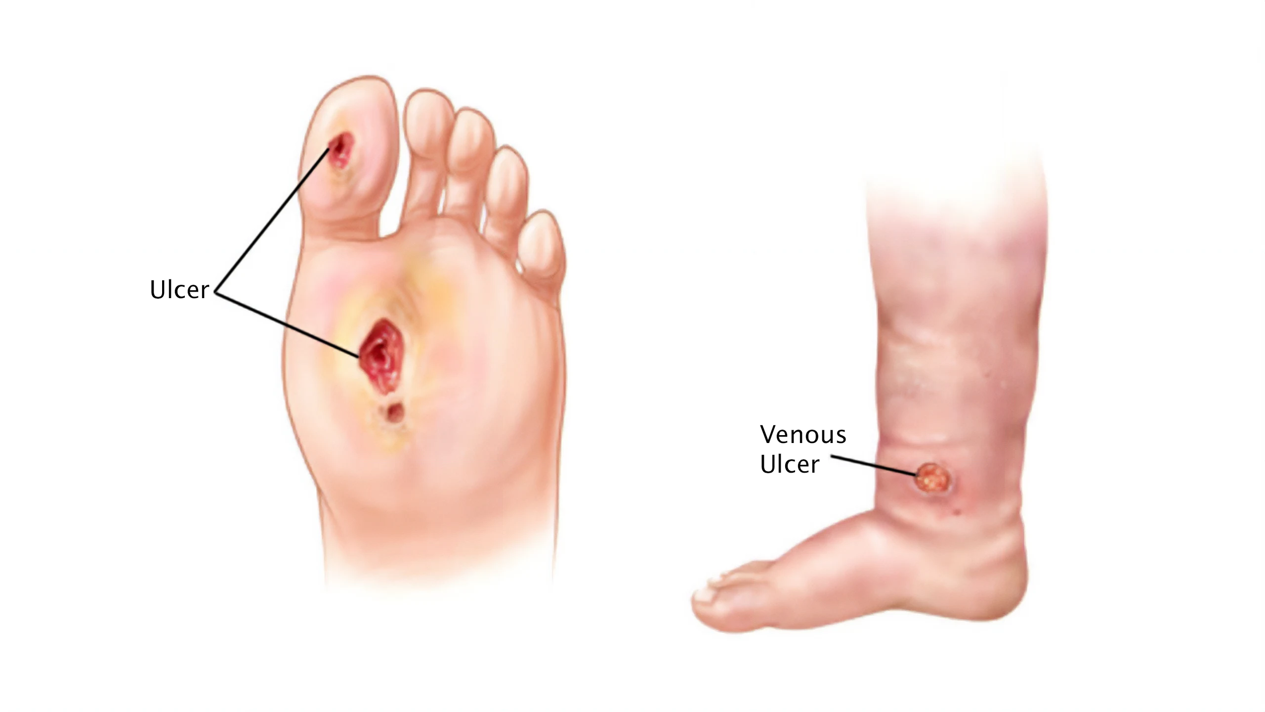 Non Healing Wounds