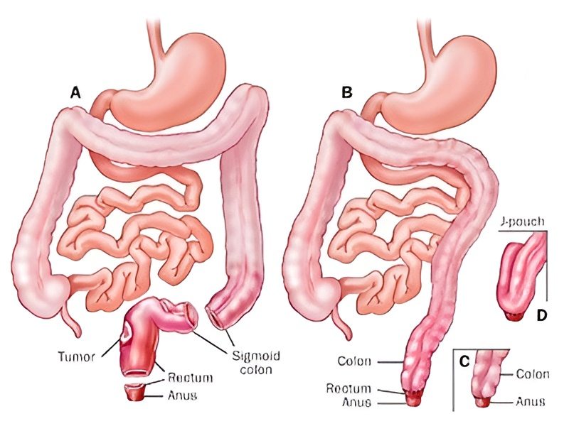 Bowel Restoration
