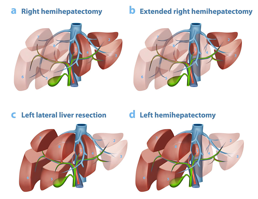 Liver resection