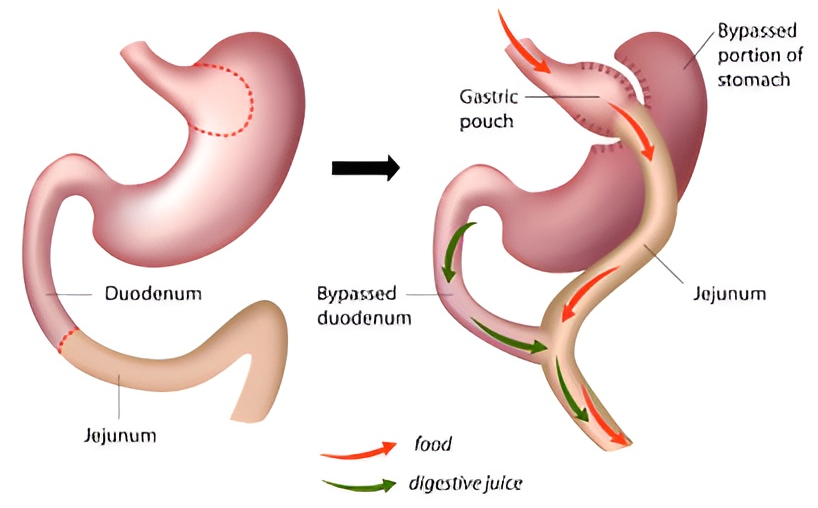 Roux en Y Gastric Bypass