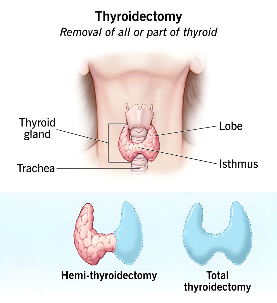 thyroidectomy 1